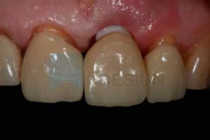 implante-zirconio