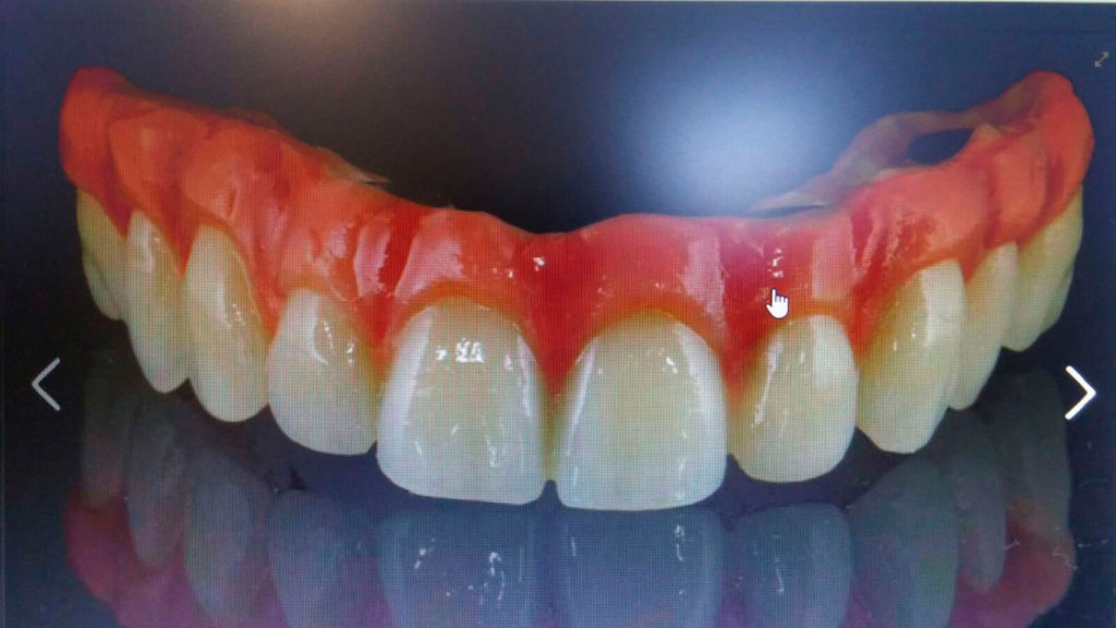 composite-dental-dentadura-biohpp
