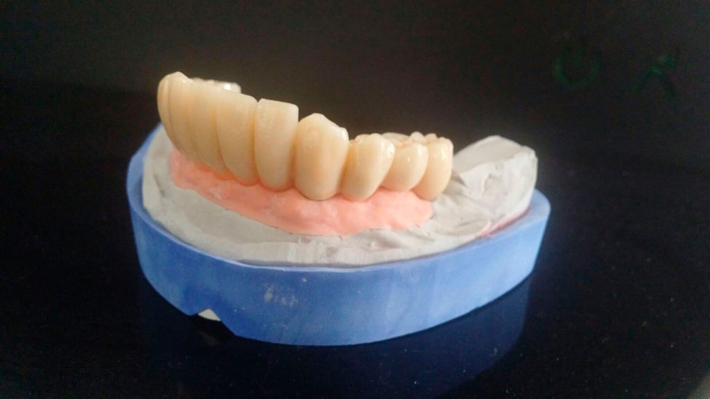 composite-dental-model-dentadura