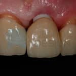 Prótesis sobre implante de zirconio