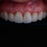 Carillas Dentales