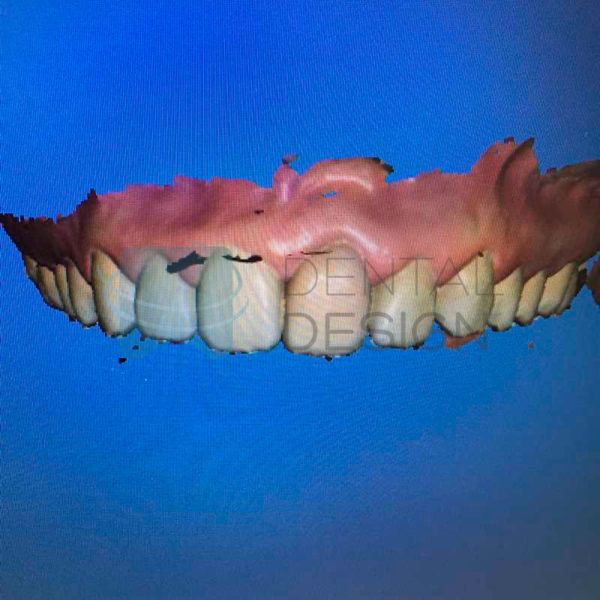pilares-personalizadoS-cad-cam5