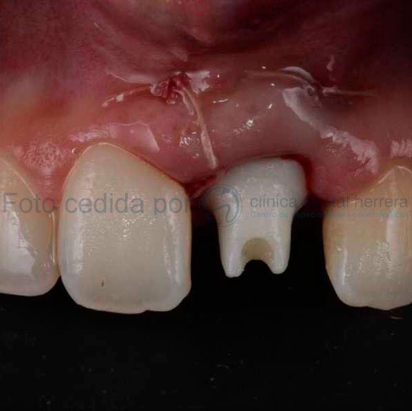 pilares-personalizadoS-cad-cam5