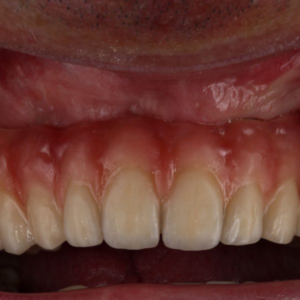 BioHPP-Inyección-Composite