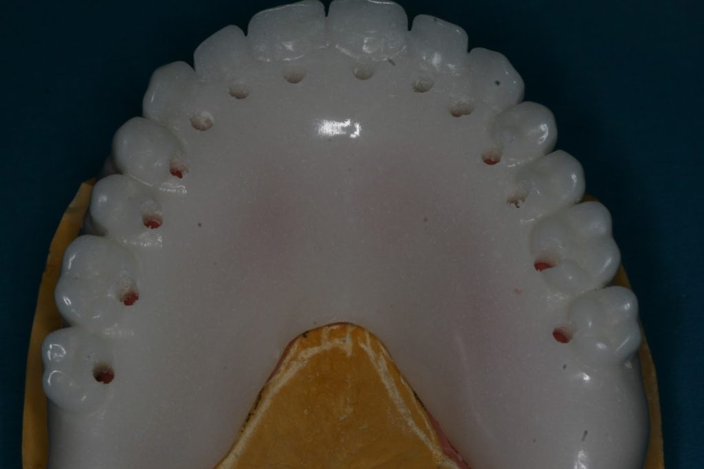 Ferula-Radiologica-para-implantes-dentales