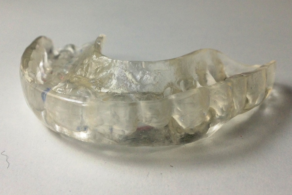 Férulas de descarga: Precios y tipos - Avilés Digital Dental Clinic