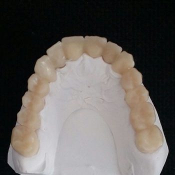 protesis-provisional-3