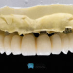 Puente de circonio sobre implantes volumen total IPS e.max ZirCAD prime