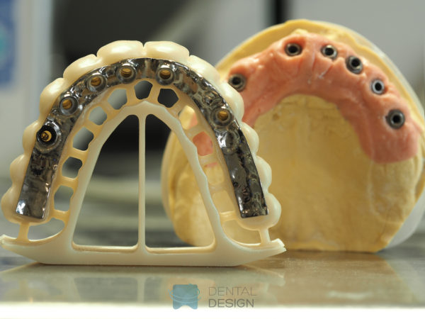 Estructura primaria en titanio y secundaria en zirconio para rehabilitación fija sobre implantes atornillada