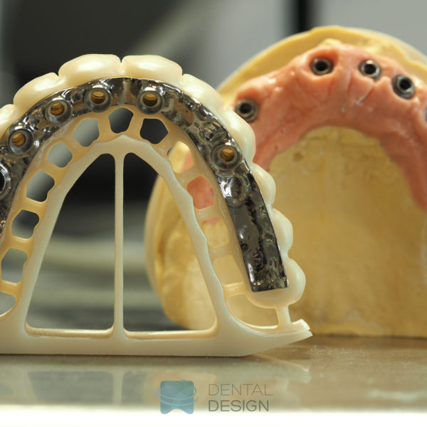 Estructura primaria en titanio y secundaria en zirconio para rehabilitación fija sobre implantes atornillada