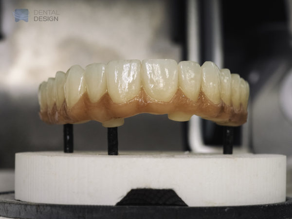 Zirconio estético monolítico multicapa, con encía en cerámica