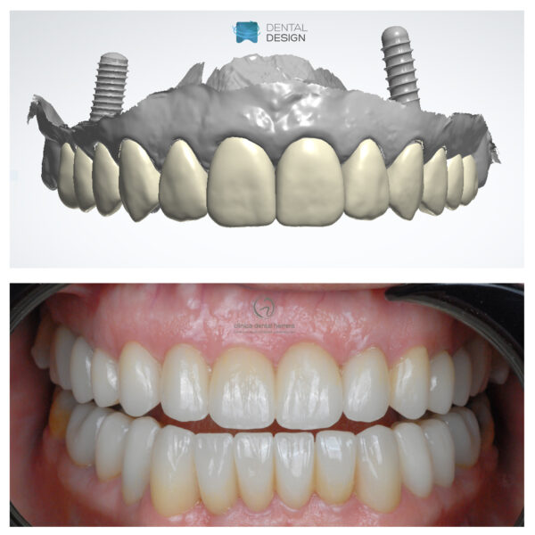 carillas estéticas empress cad multi1 y coronas sobre implante en circonio Aidite2